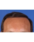 After Hair Transplant &nbsp;Front